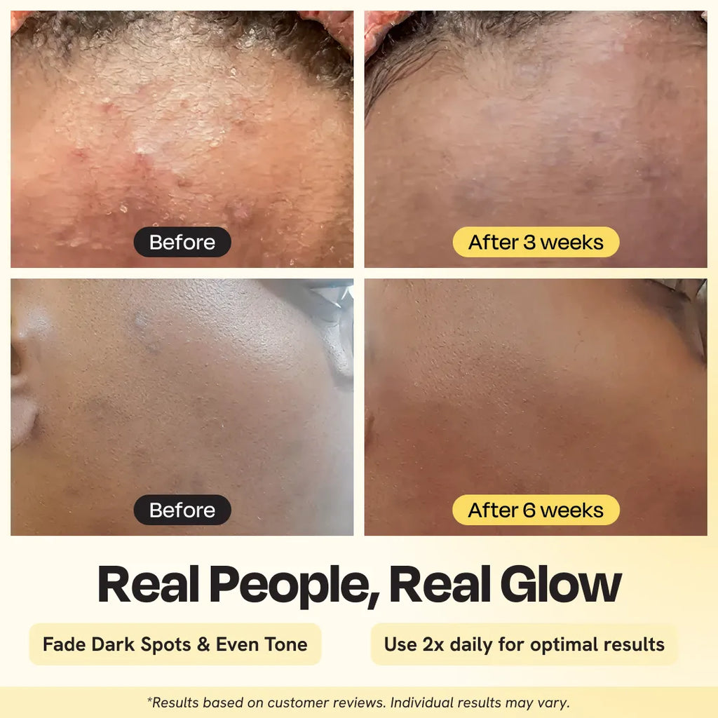 Before and after skin treatment results showing dark spots fading over time.